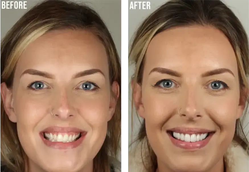 case-veneer1-1024x762-1