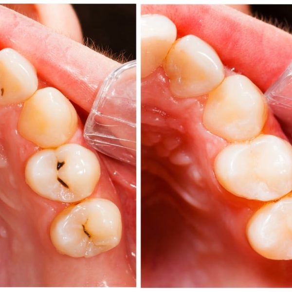 Composite-Tooth-Colored-Fillings-1.jpg.optimal