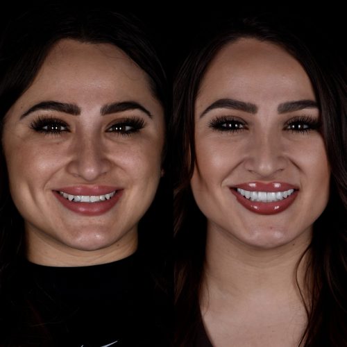 Porcelain Dental Veneers dubai uae dubai 9