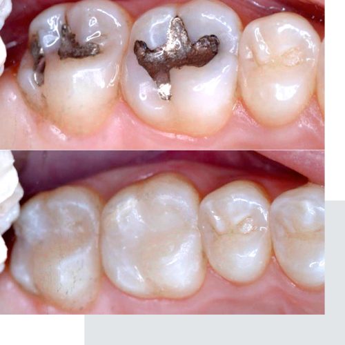 cosmetic-dentist-Mumbai-composite-resin-fillings-11