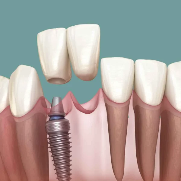 dental-implant-on-front-tooth-2