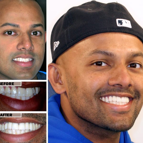 veneers-dubai-before-after
